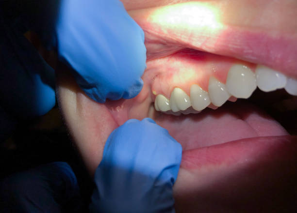 Best Dental Abscess Treatment in Worthington, KY