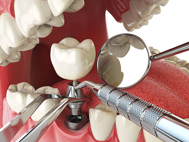 Best Emergency Wisdom Tooth Extraction in Worthington, KY